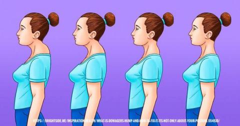 The dowager's hump